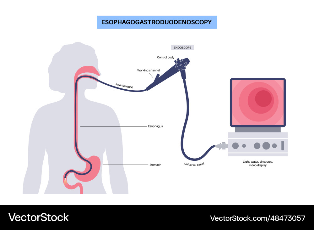 Esophagogastroduodenoscopy medical procedure Vector Image