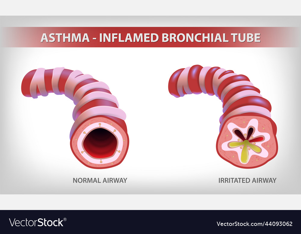 Shows two parts of the bronchi one normal Vector Image