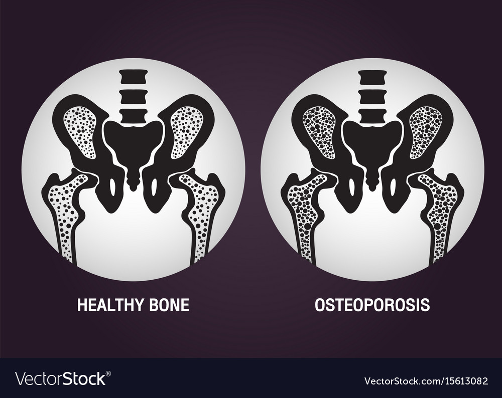 Osteoporosis logo icon design Royalty Free Vector Image