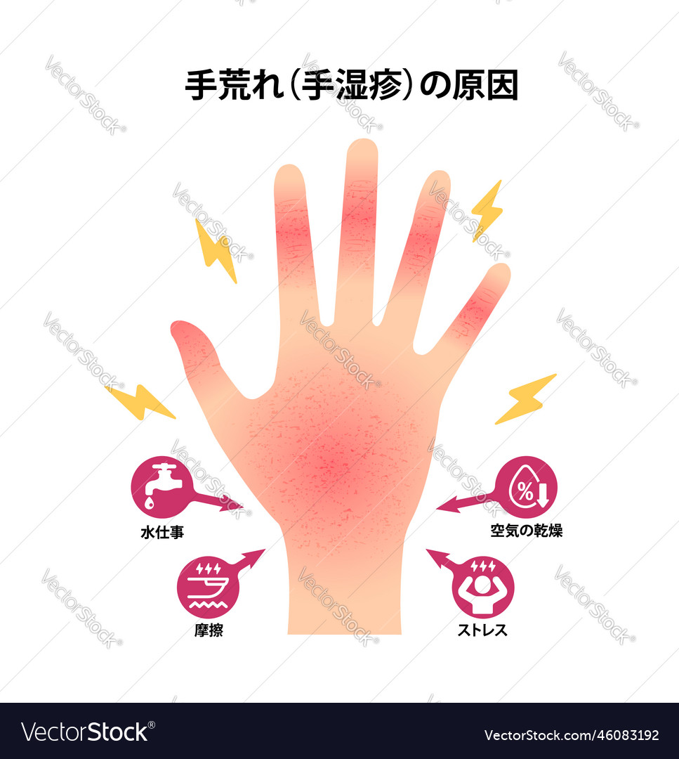 Causes of dry and rough hands chapped hands Vector Image