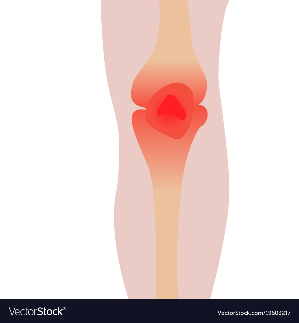 Knee injury Royalty Free Vector Image - VectorStock