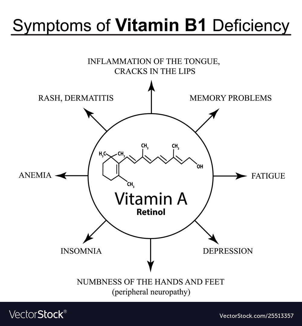 Symptoms Vitamin B1 Deficiency Infographics Vector Image