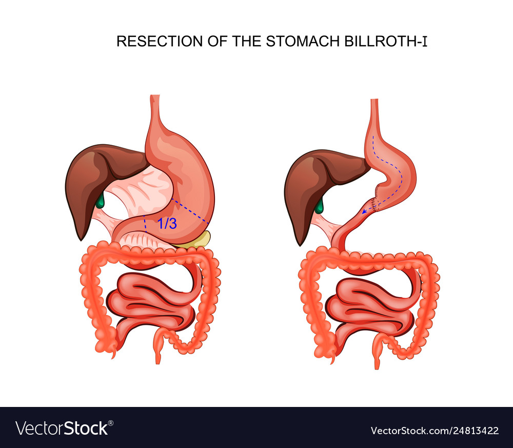 Scheme resection stomach billroth 1