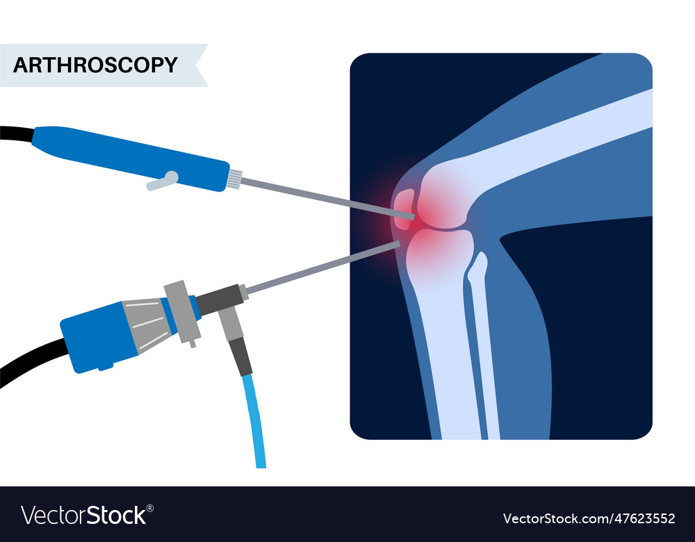 Knee joint arthroscopy Royalty Free Vector Image