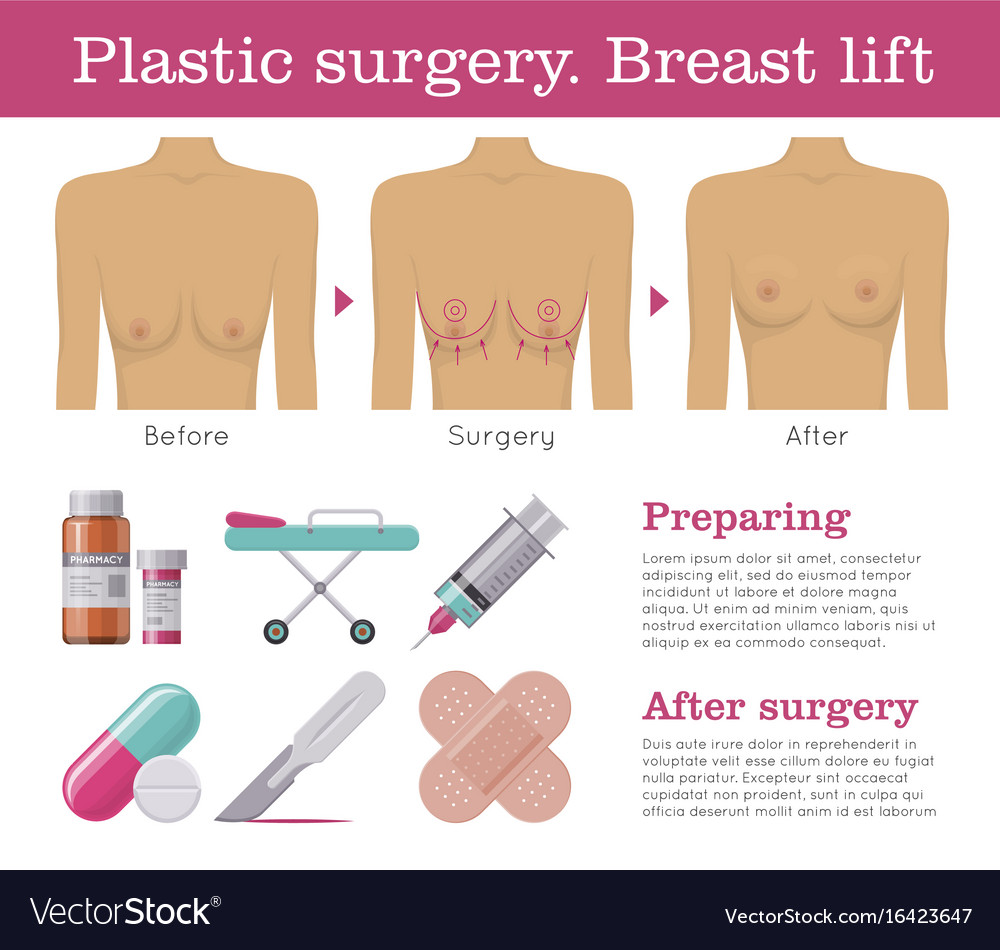 A Breast Lift: Over 1,678 Royalty-Free Licensable Stock Vectors & Vector  Art