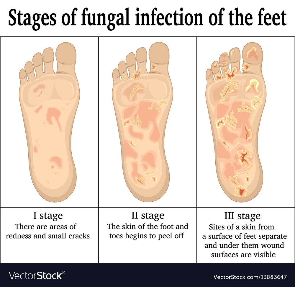 Fungal Infection On Feet Royalty Free Vector Image