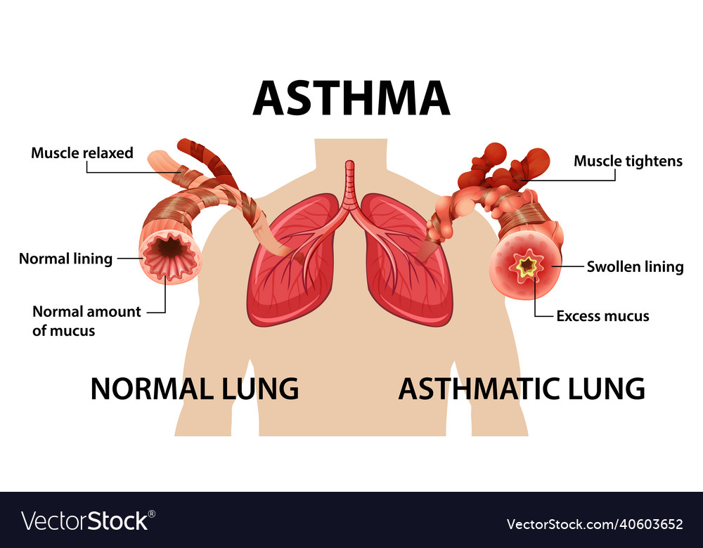 Bronchial asthma diagram with normal lung