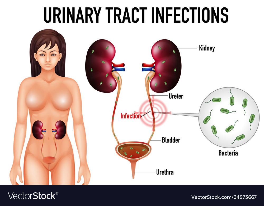 Informative urinary tract infections