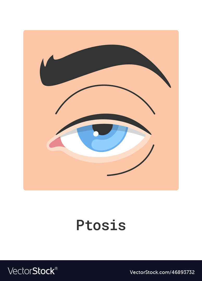 Ptosis human eye disease Royalty Free Vector Image