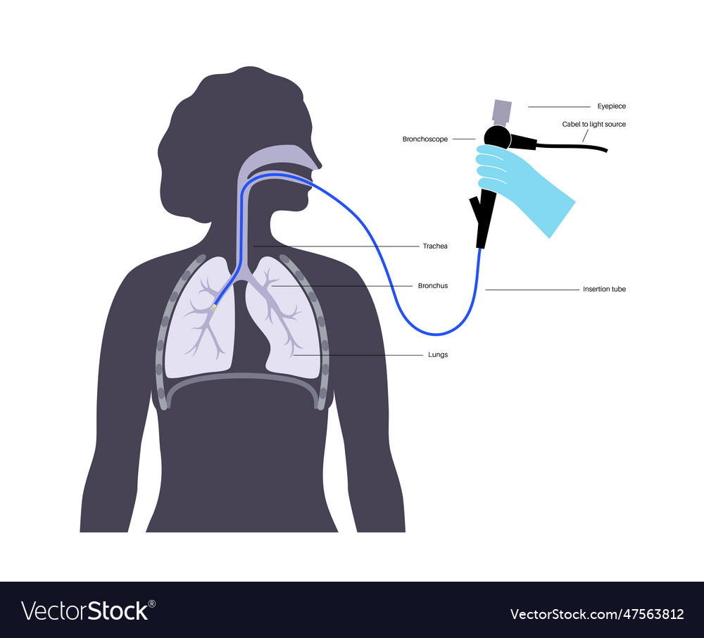 Bronchoscopy procedure concept Royalty Free Vector Image