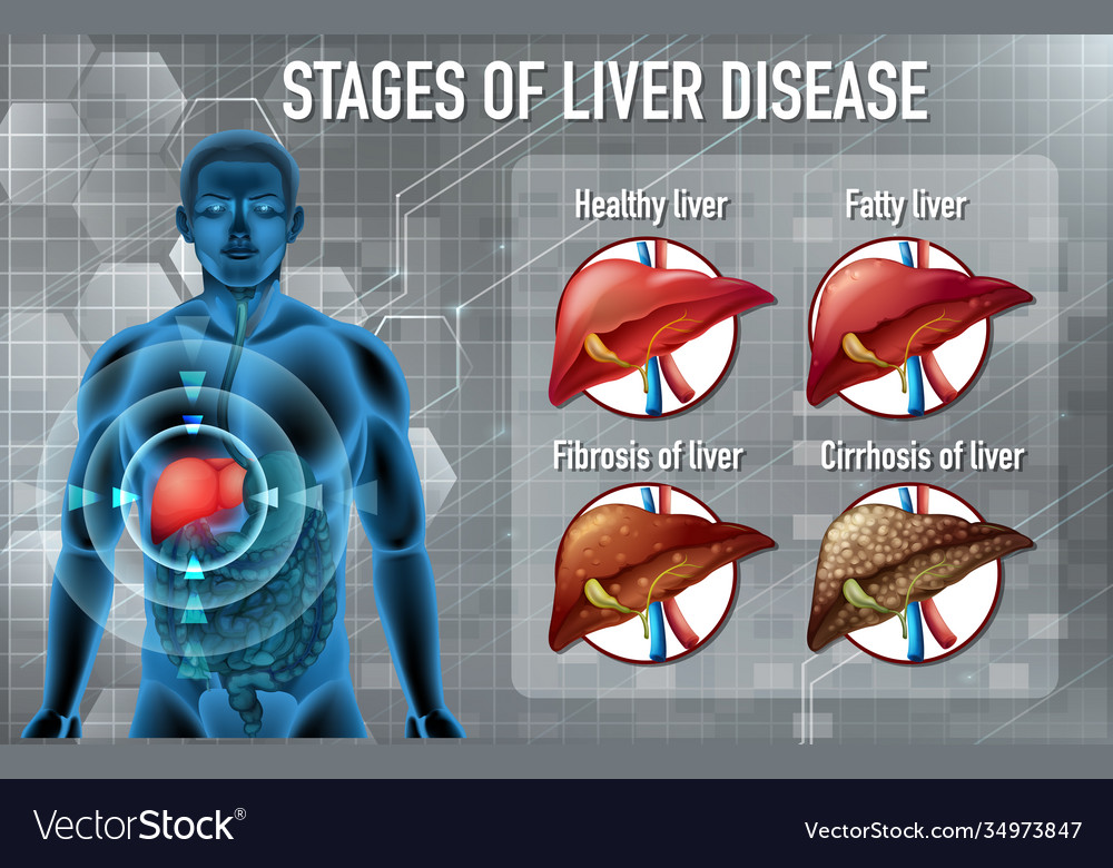 Photo Of Stages Of Liver Disease Id Royalty Free Image Hot Sex Picture 5508