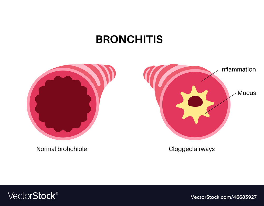 Bronchitis Lung Krankheit