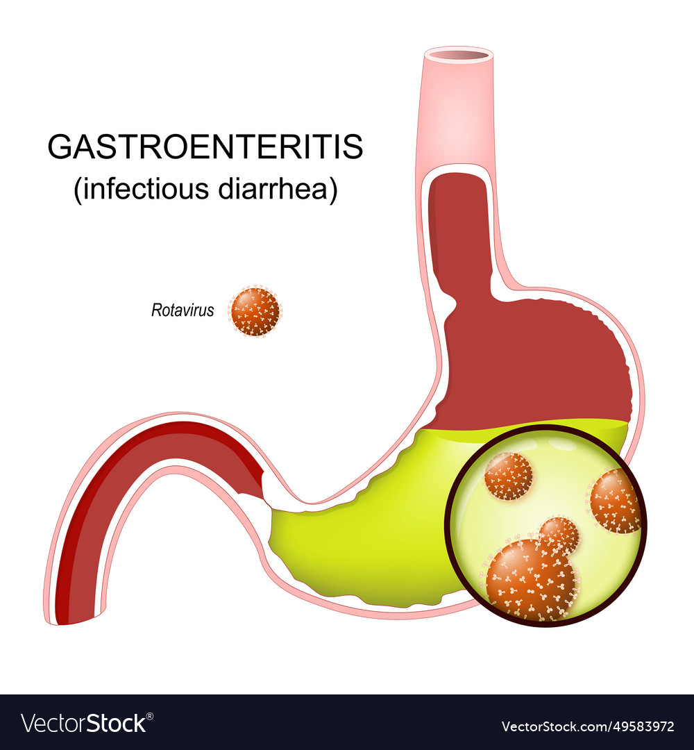 Gastroenteritis stomach flu or infectious diarrhea