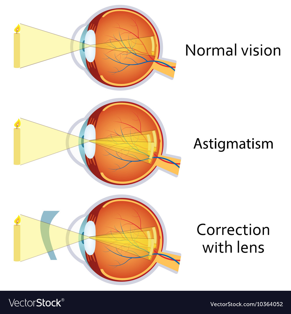 Astigmatism Corrected A Cylindrical Lens Vector Image