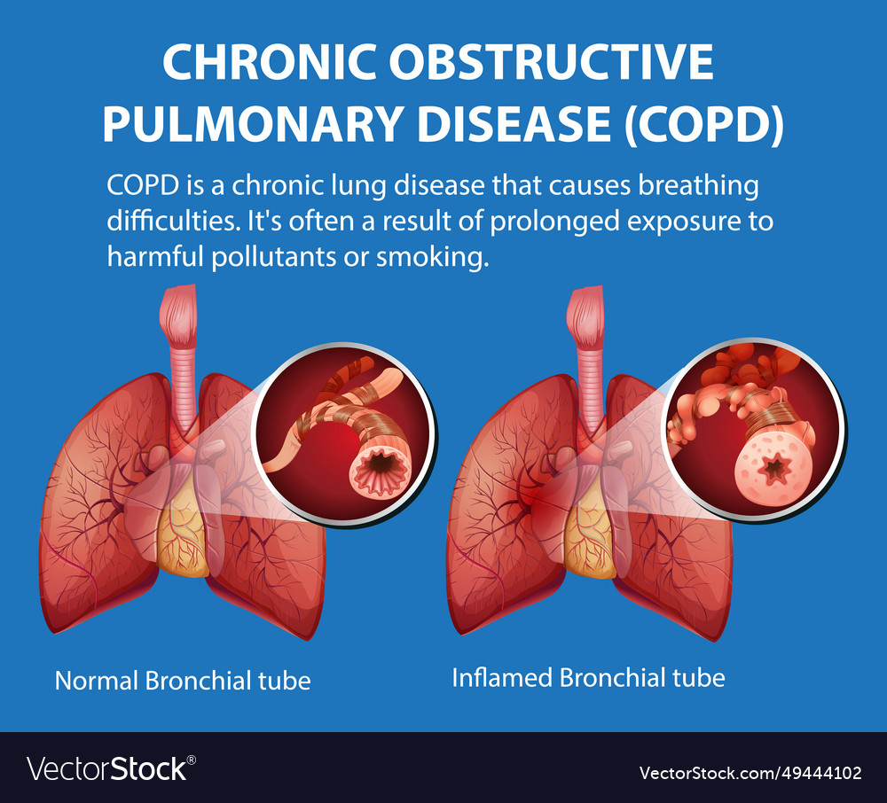 Science education of human anatomy copd Royalty Free Vector