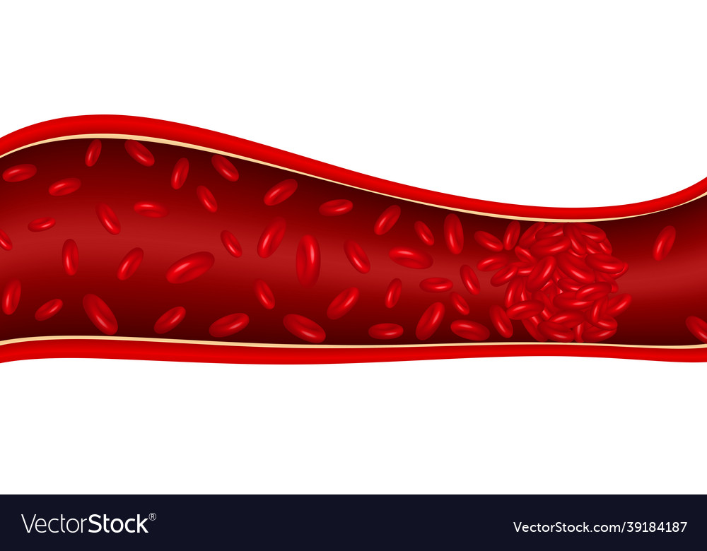 Blood Clot In Vein Royalty Free Vector Image - Vectorstock