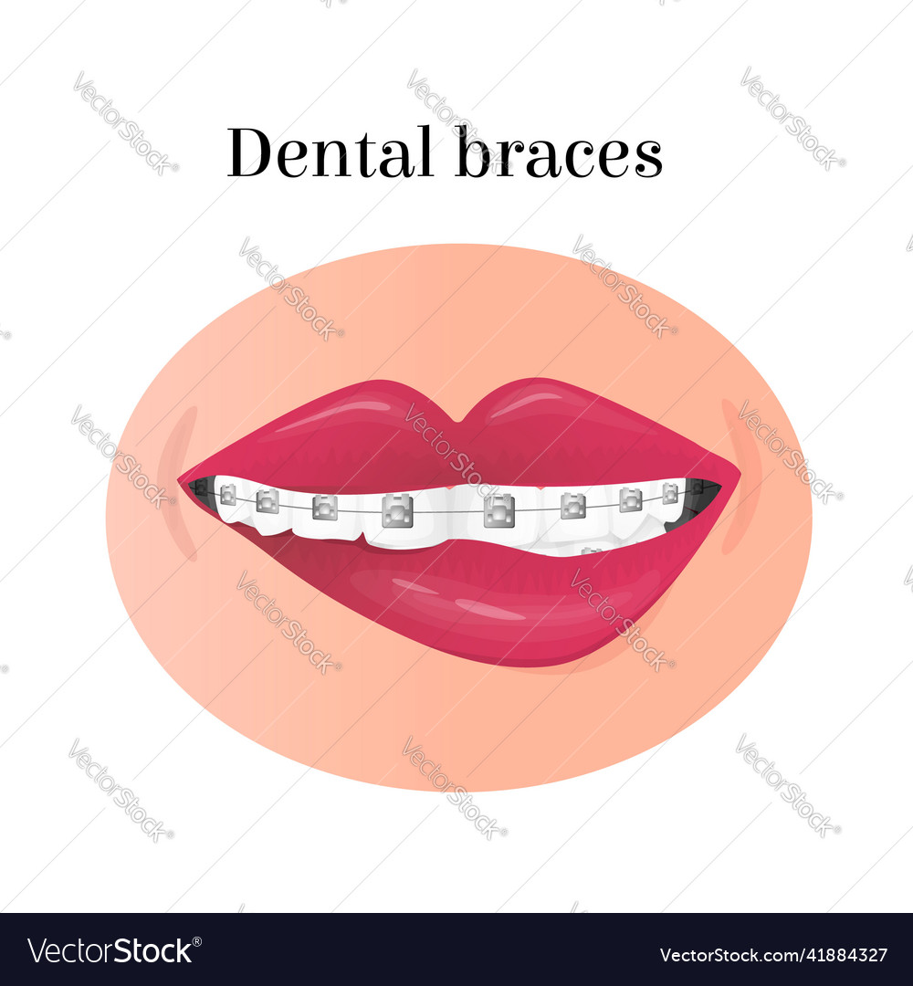 Image of mouth with teeth in dental braces Vector Image