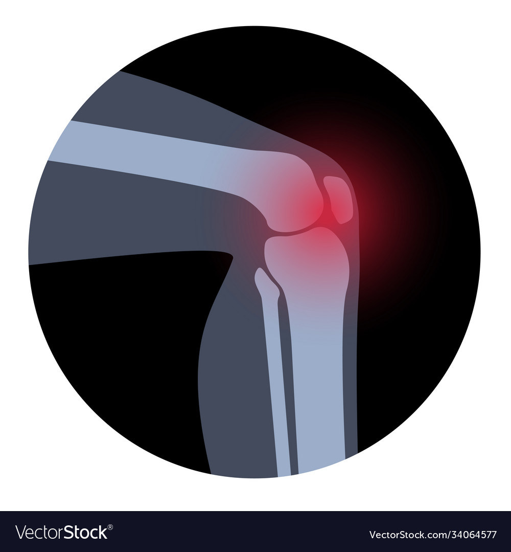 Arthritis in knee joint Royalty Free Vector Image