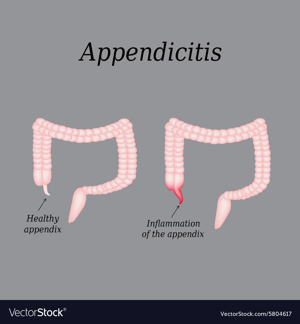 Appendicitis inflammation of the appendix colon Vector Image