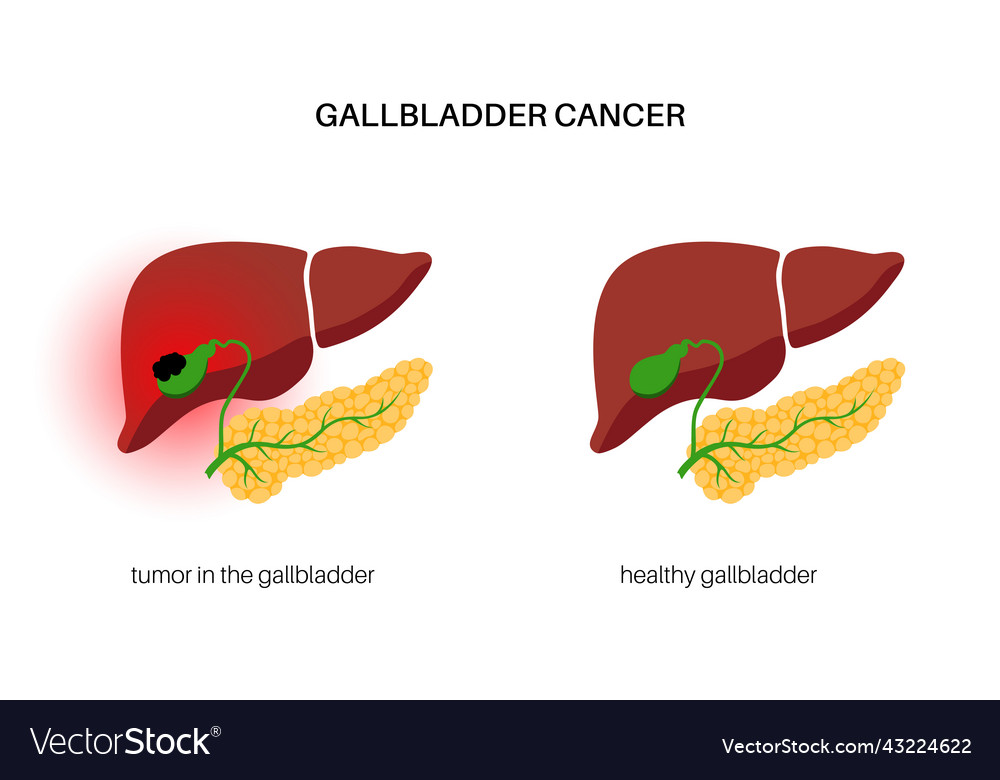 Gallbladder cancer anatomy Royalty Free Vector Image