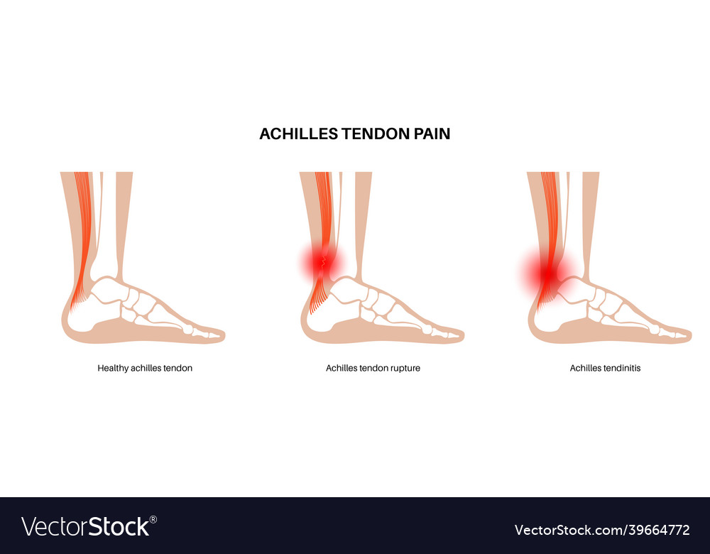 Achilles tendon injury Royalty Free Vector Image