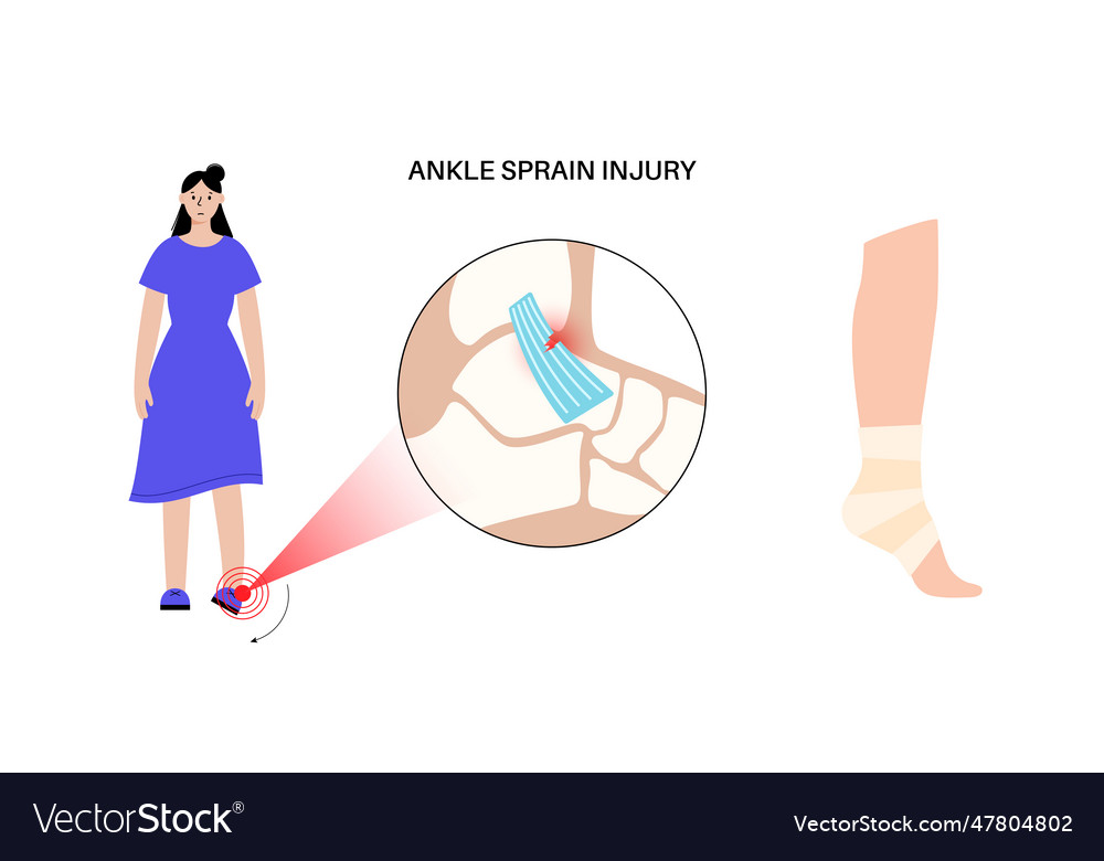 Sprained ankle injury Royalty Free Vector Image