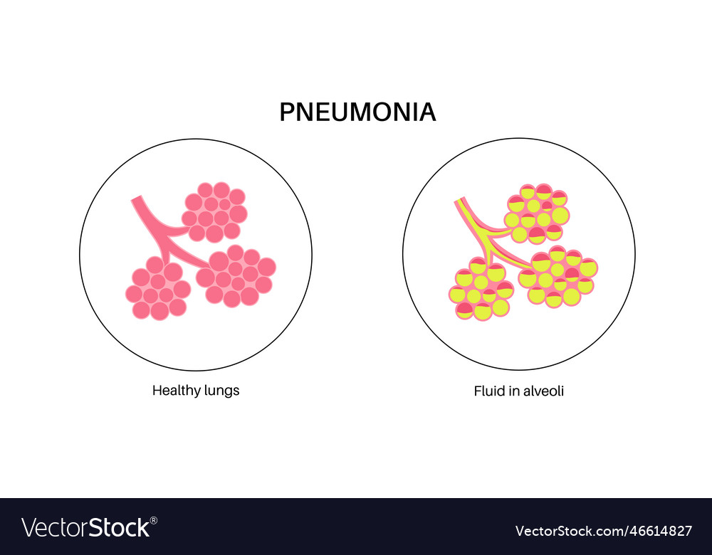 Pneumonia infection poster Royalty Free Vector Image