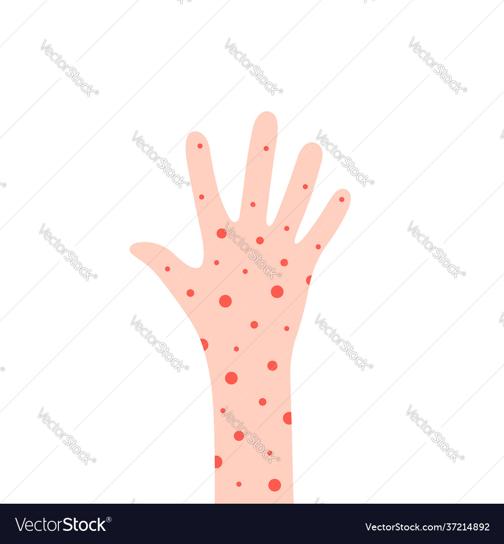 Cartoon hand with rash like allergy Royalty Free Vector