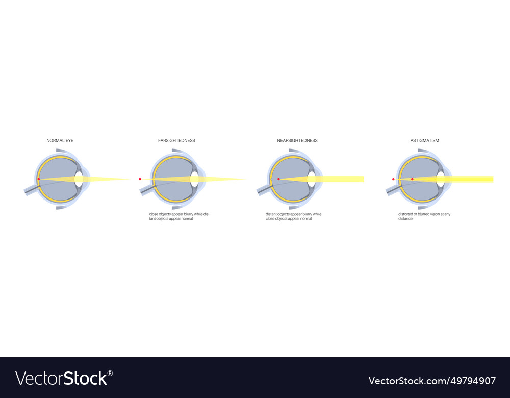 Refractive Errors Poster Royalty Free Vector Image