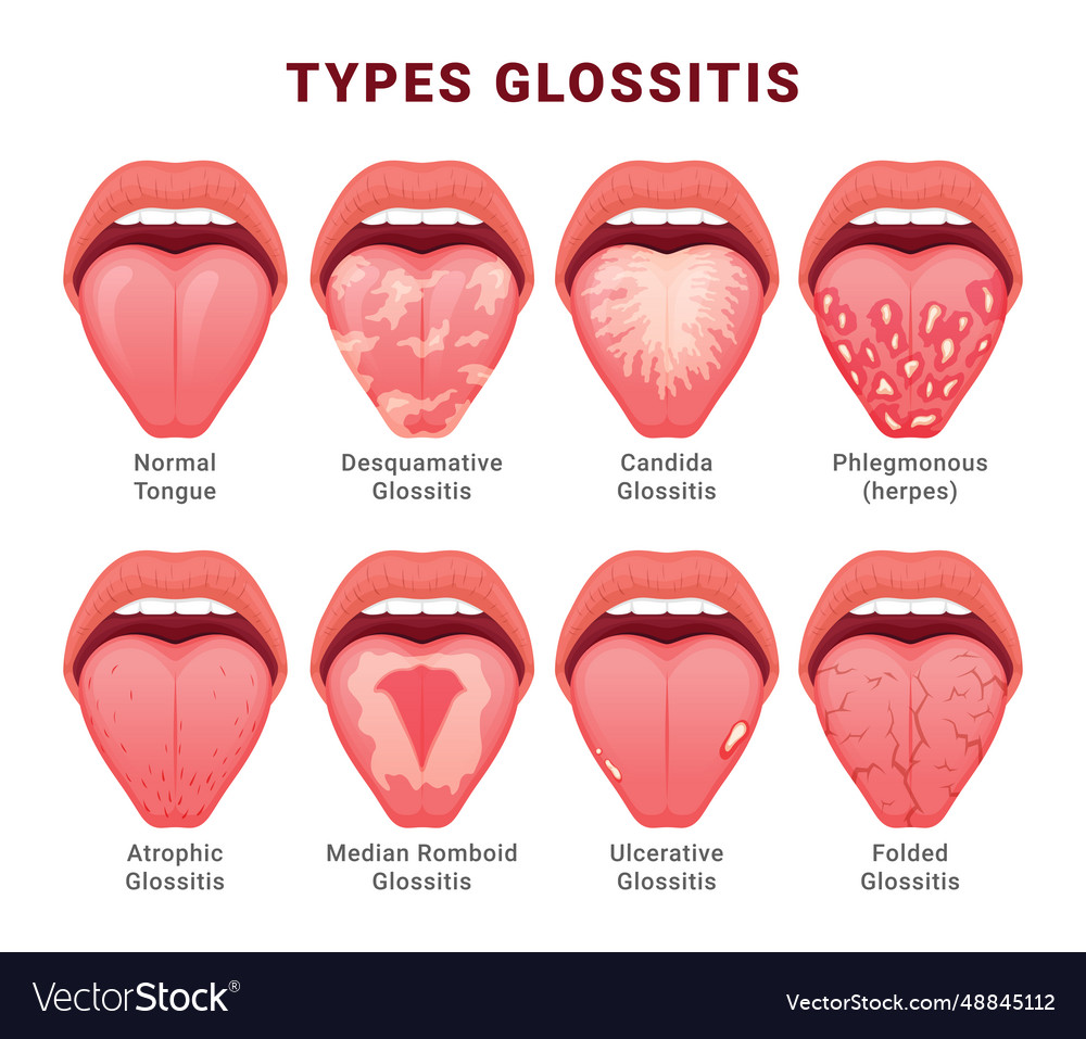 Glossitis type candidiasis of tongue thrush Vector Image