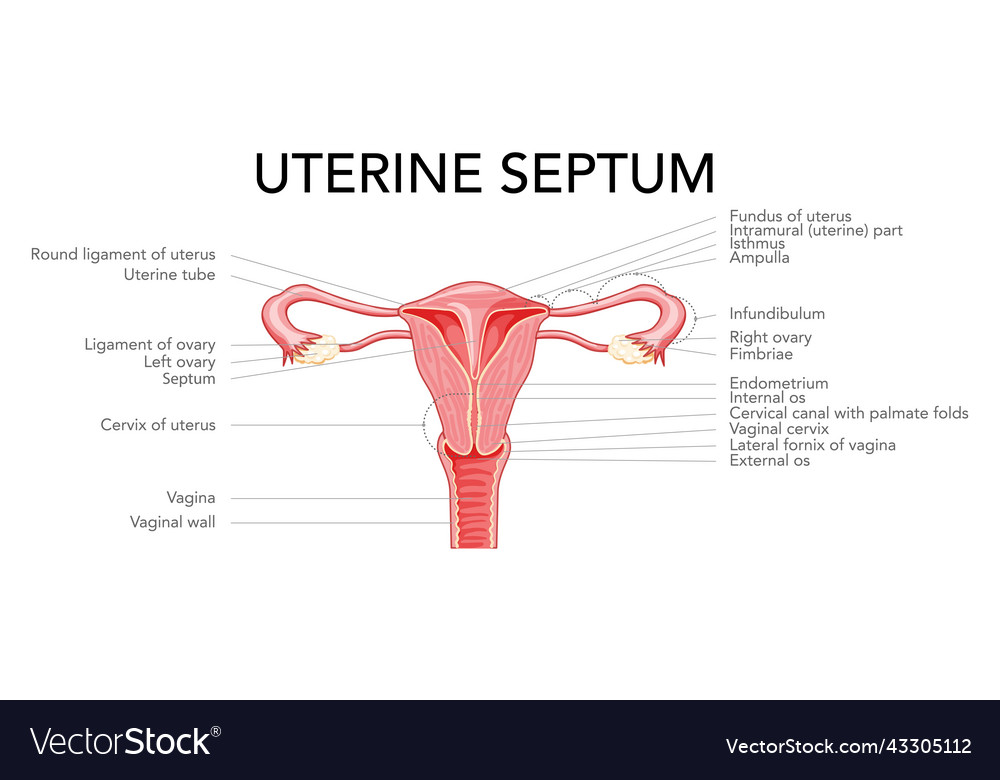 Uterin Septum septat Uterus weibliche reproduktive vector image Uterin Septum septat Uterus weibliche reproduktive
