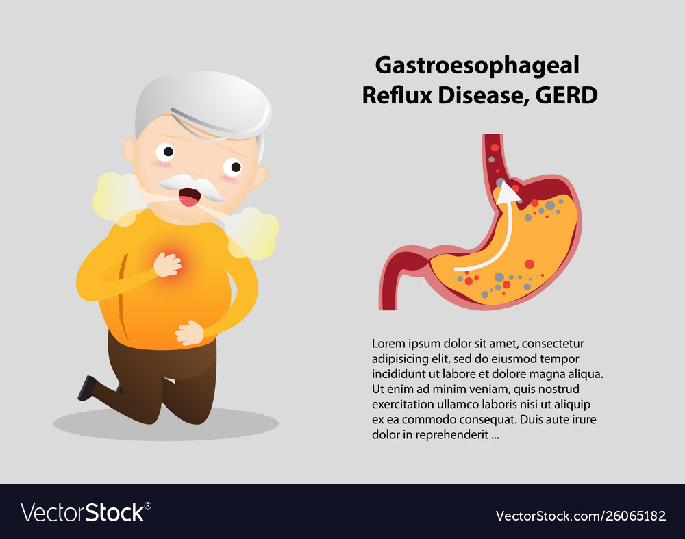 Gastro-esophageal reflux disease gerd