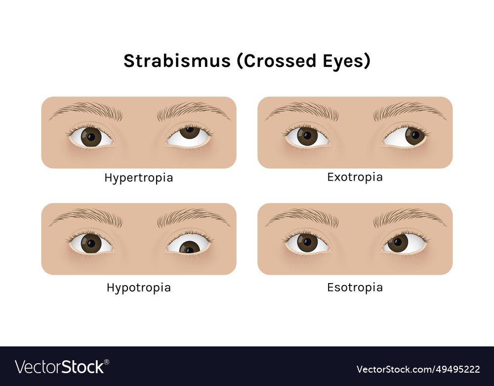 Realistic human eyes with strabismus Royalty Free Vector