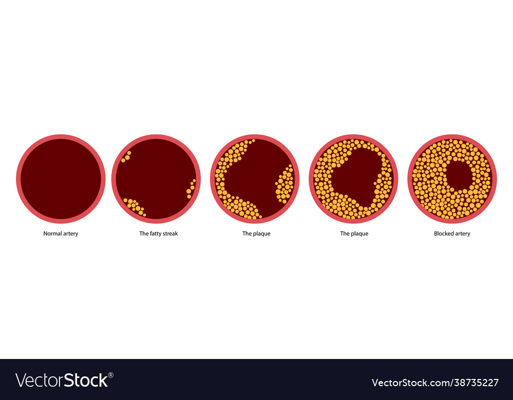 Cholesterol and atherosclerosis vector image Cholesterol and atherosclerosis