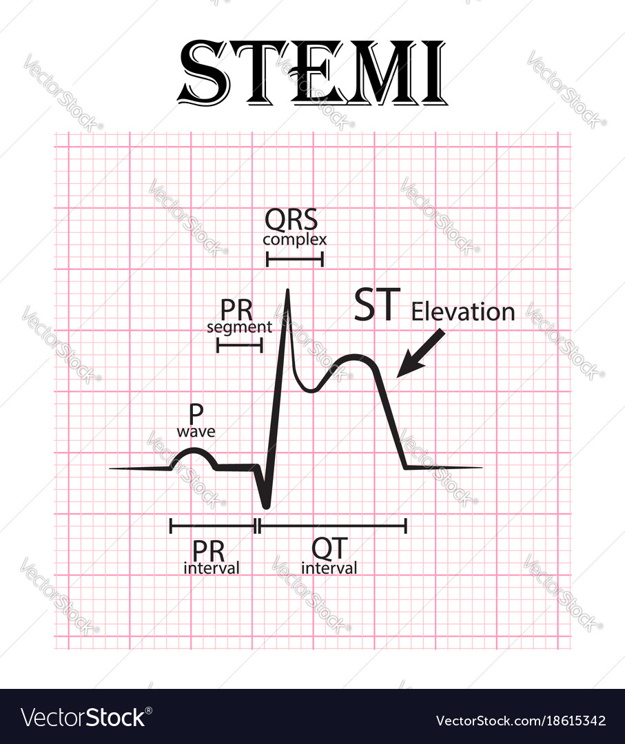 Ecg of st elevation myocardial infarction stemi Vector Image