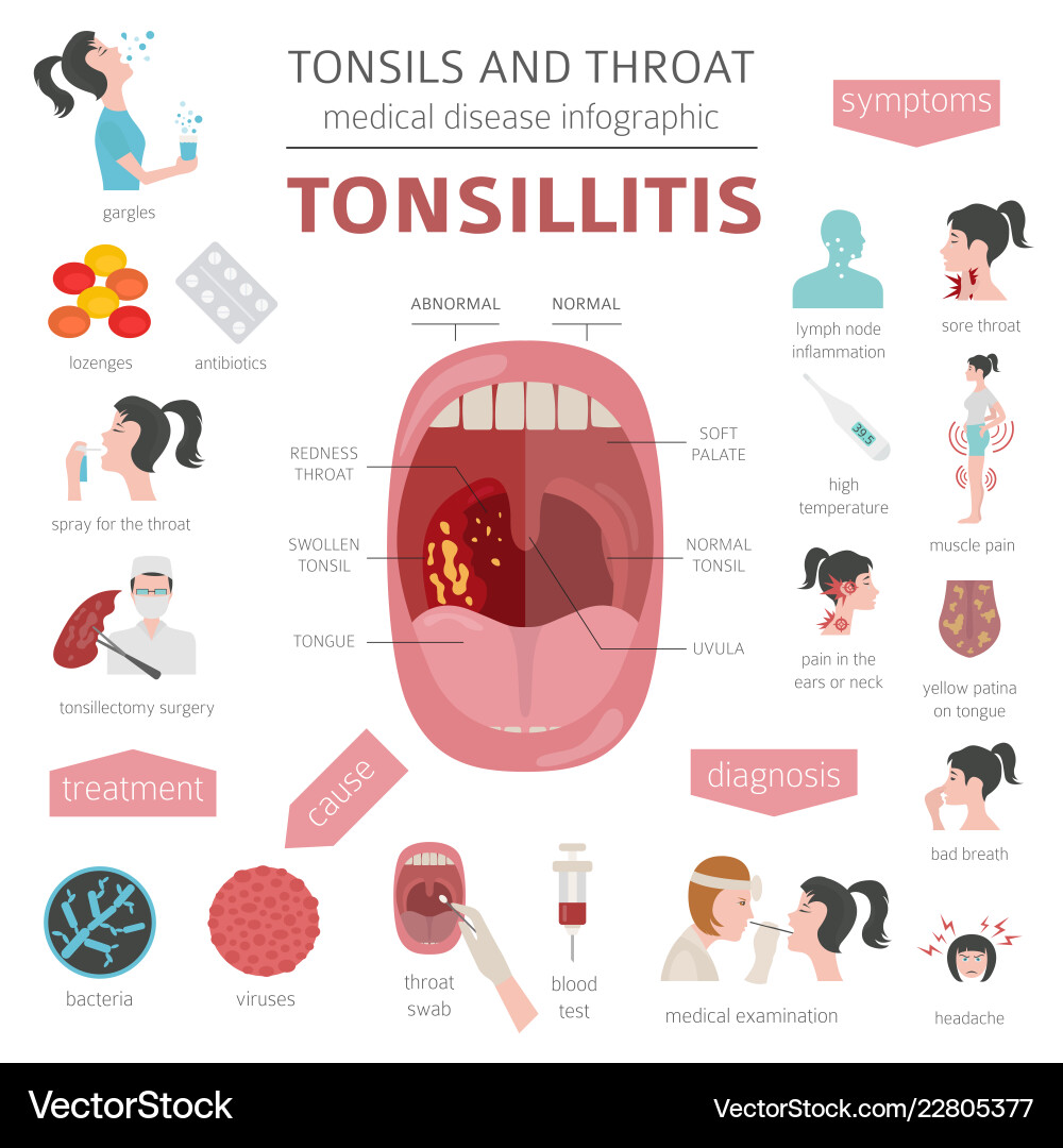 Tonsils and throat diseases tonsillitis symptoms Vector Image