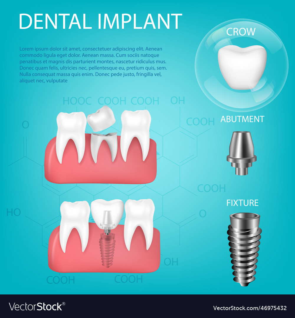 Realistic 3d set of dental implants