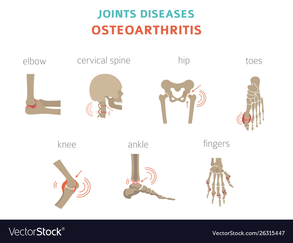 Arthritis Osteoarthritis Medical Infographic Vector Image