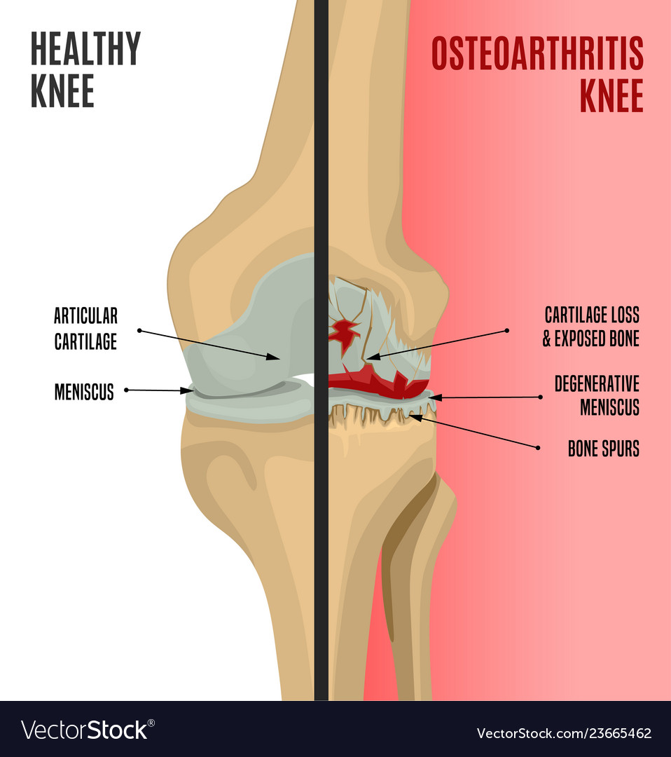 Osteoarthritis knee poster Royalty Free Vector Image