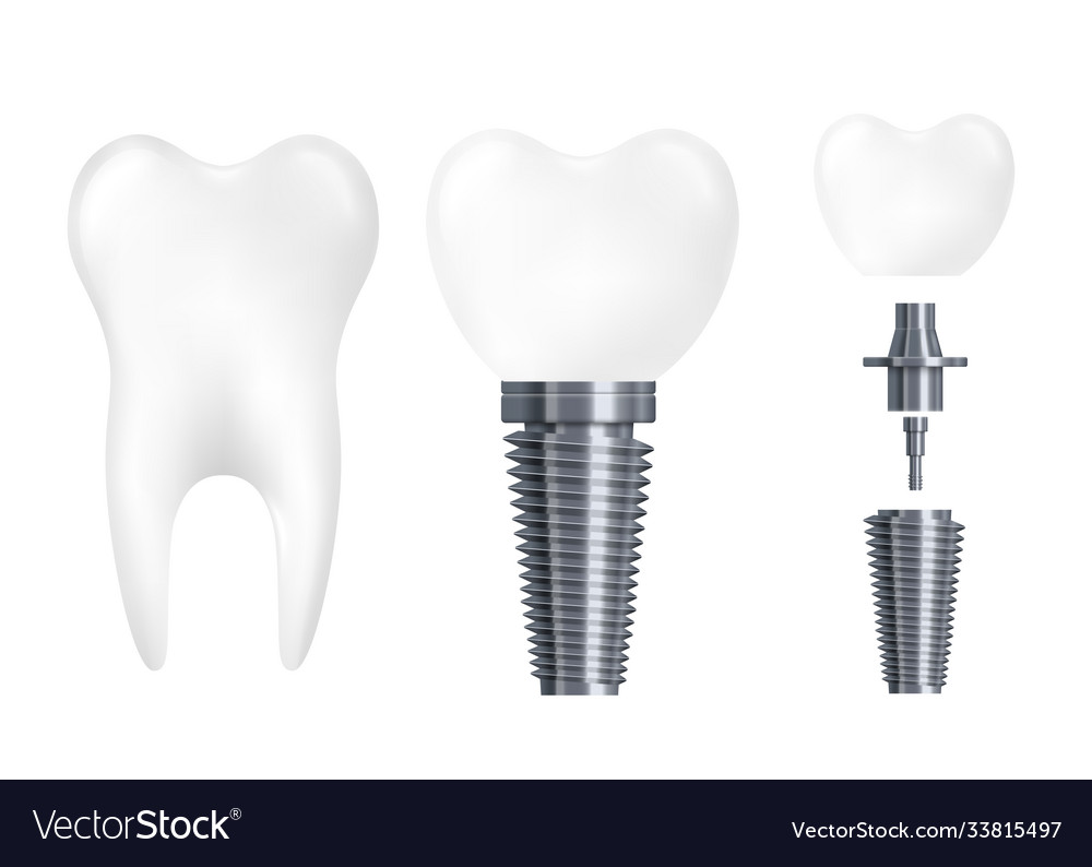 Dental implant parts - realistic white tooth Vector Image