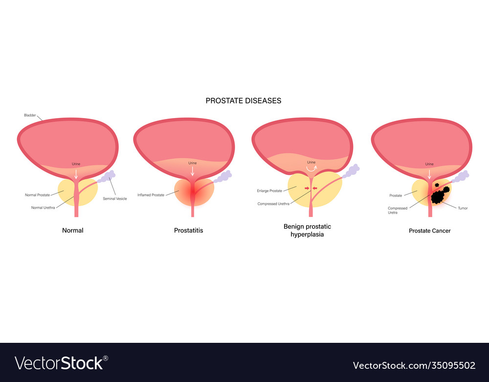 Prostate cancer concept Royalty Free Vector Image