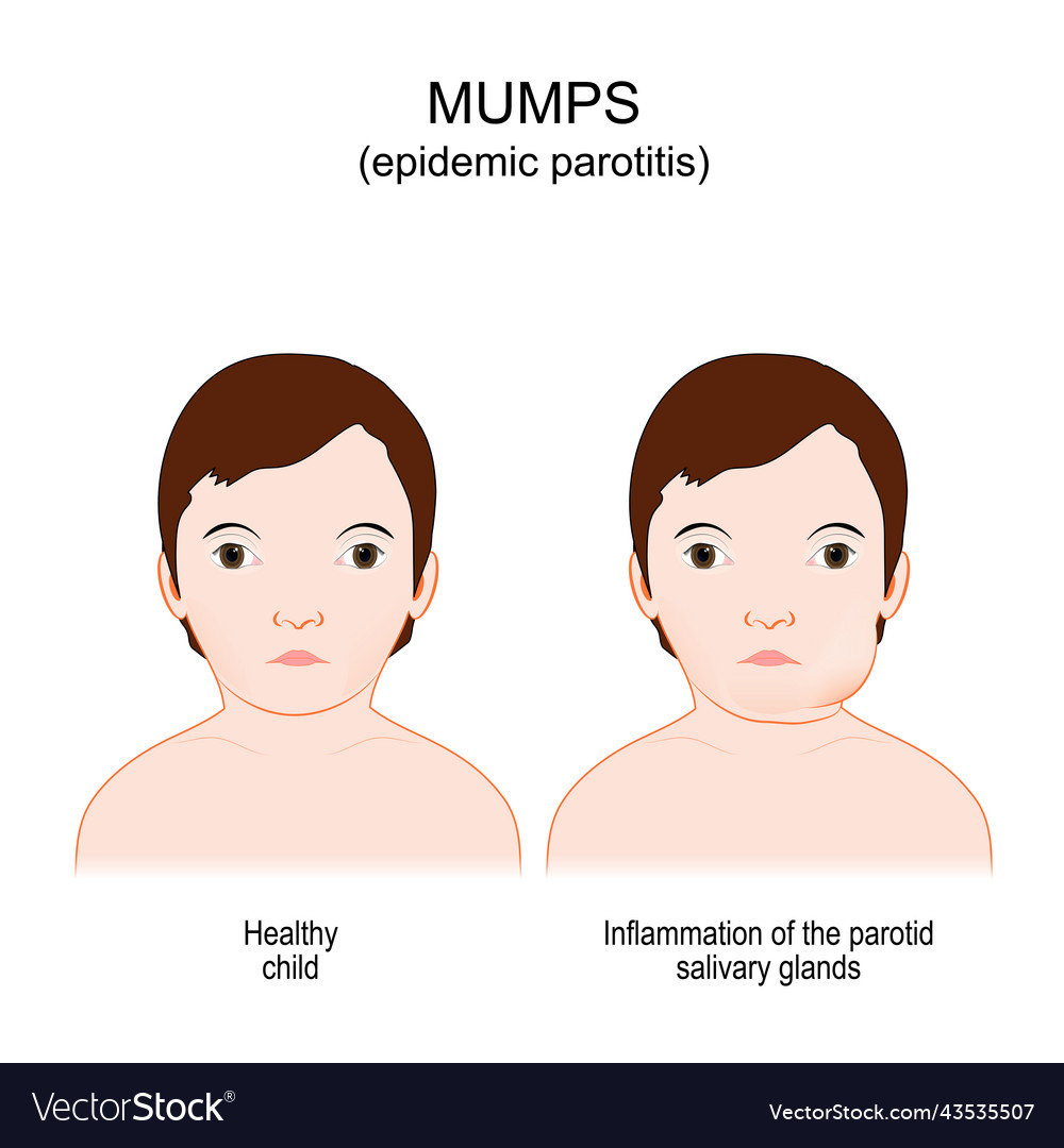 Mumps epidemic parotitis viral disease Royalty Free Vector