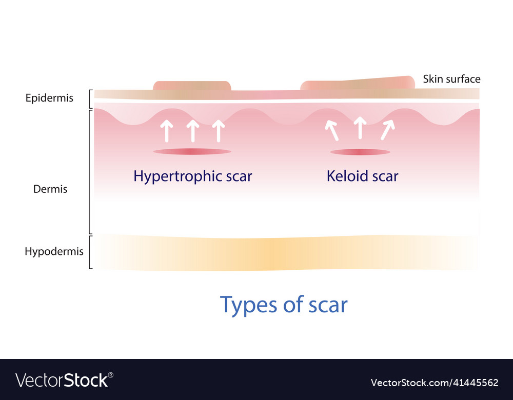 Keloid Scar And Hypertrophic On Skin Surface Vector Image