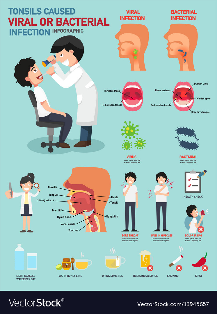 Tonsils Caused Viral Or Bacterial Infection Vector Image