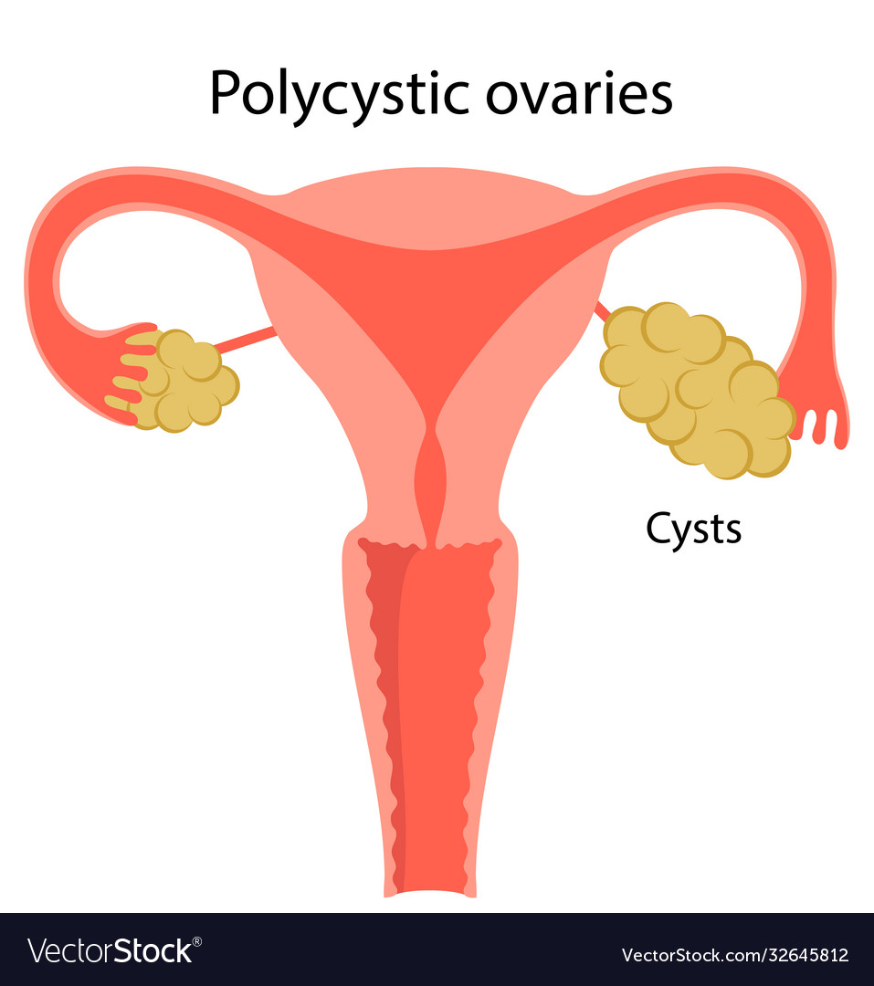 Polycystische Ovarien