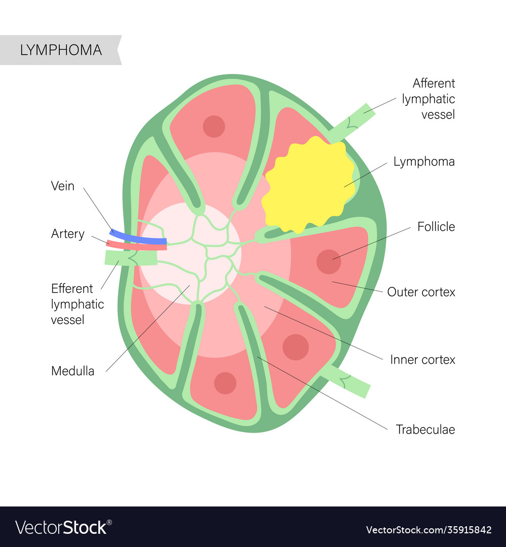 Lymphoma cancer concept Royalty Free Vector Image