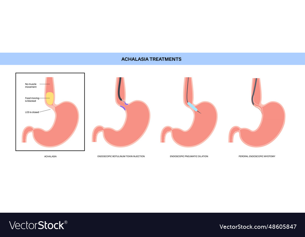 Achalasia Behandlungsverfahren