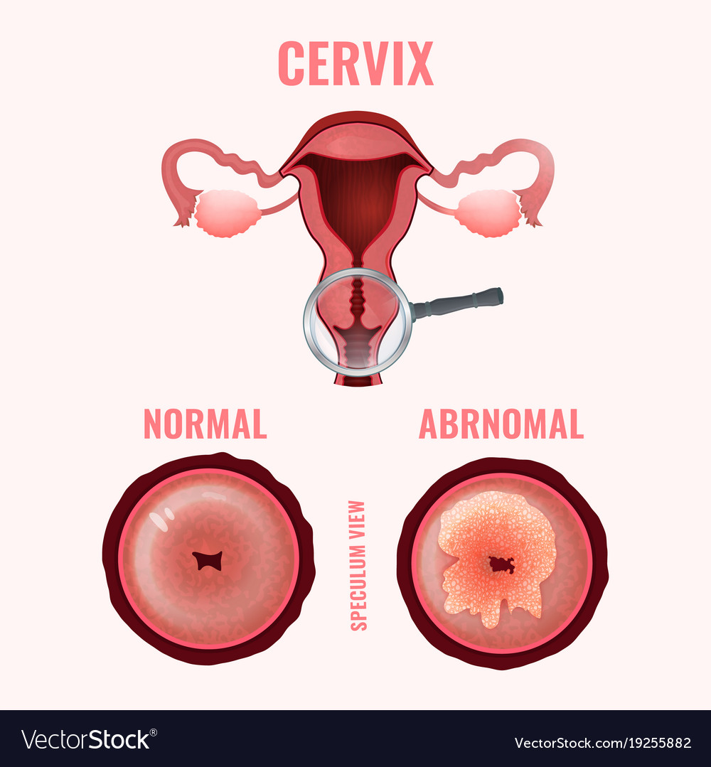 Cervical Cancer Image Royalty Free Vector Image