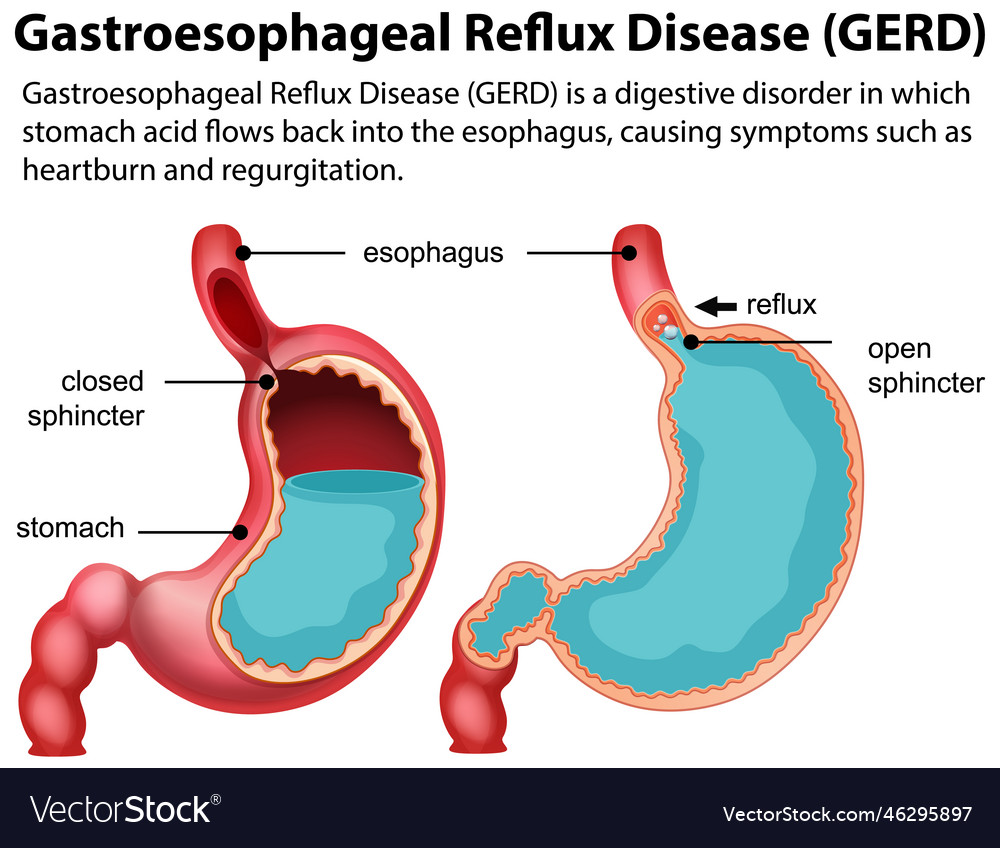 Gastroesophageal reflux disease gerd diagram vector image Gastroesophageal reflux disease gerd diagram