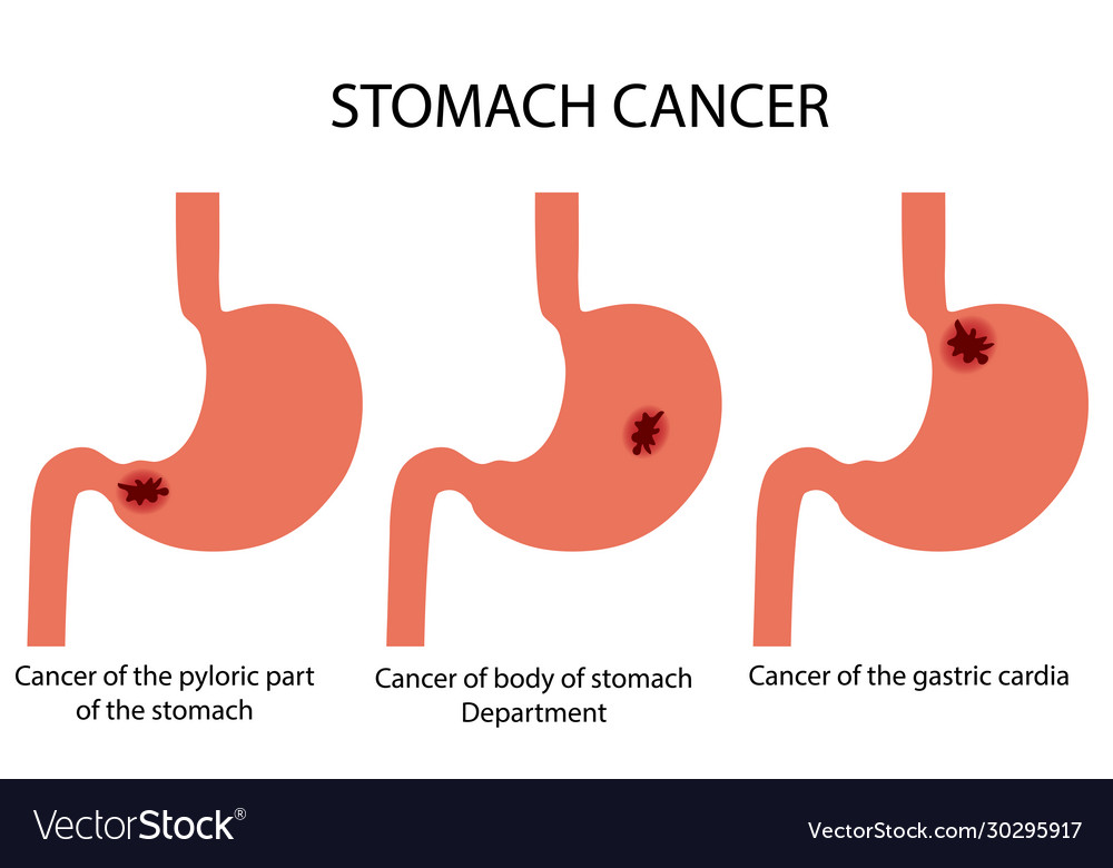 Stomach disease Royalty Free Vector Image - VectorStock